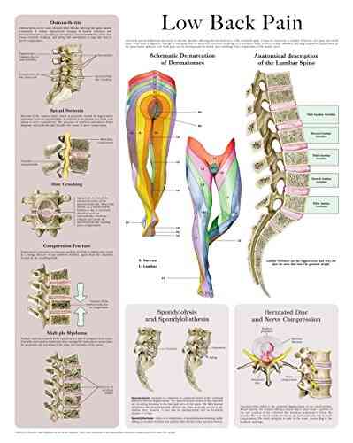 Low Back Pain E Chart: Quick Reference Guide