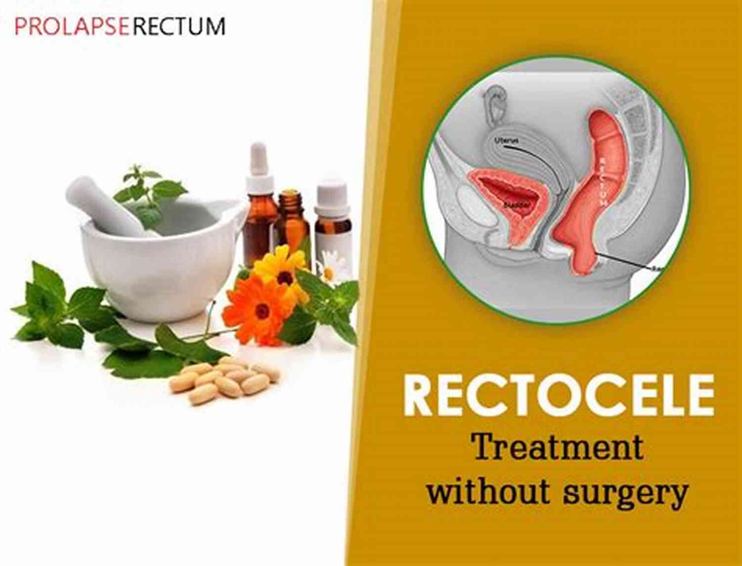 Herbal Supplements For Rectal Prolapse Jini S Healing Guide: Natural Treatments For Rectal Prolapse
