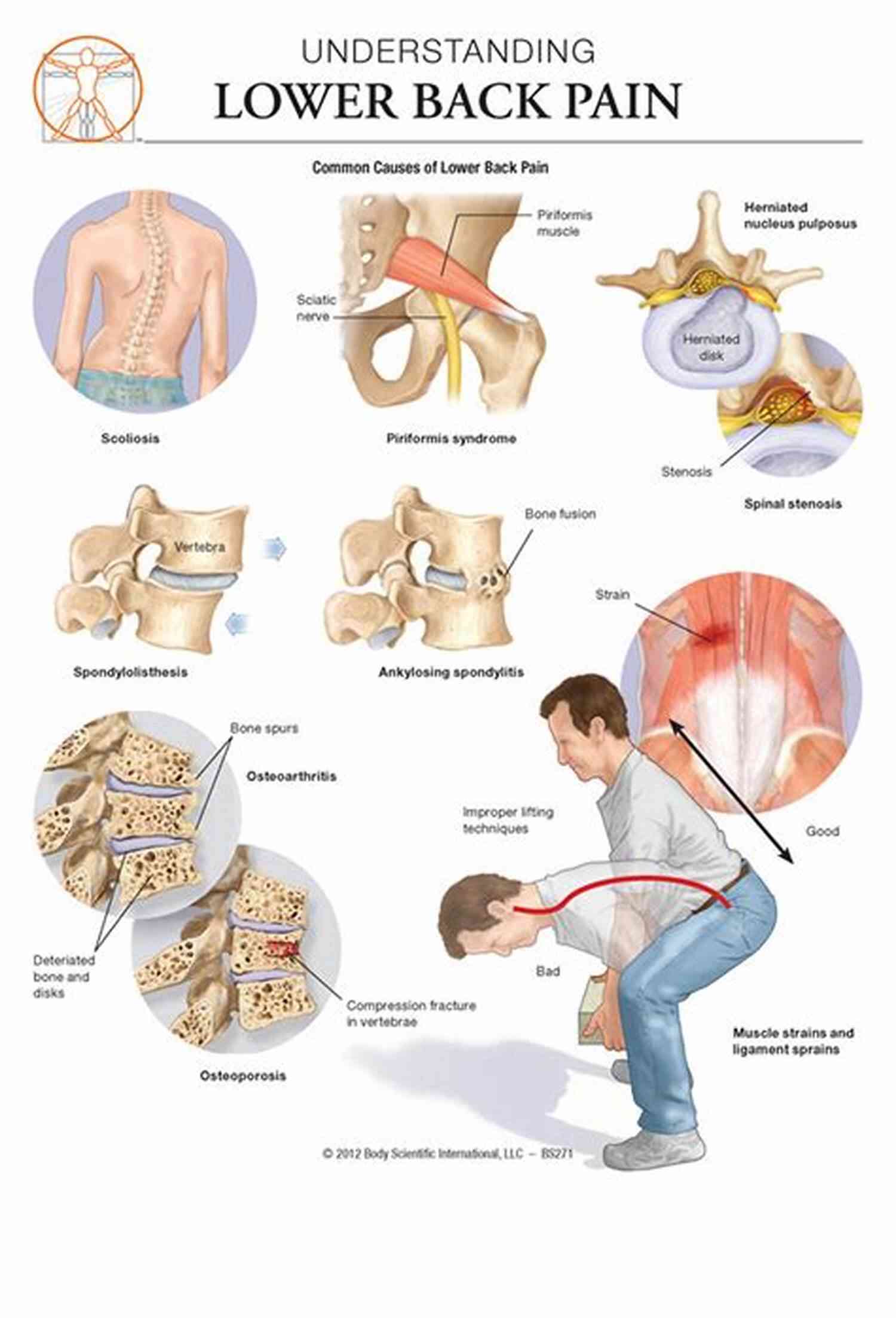 Low Back Pain Chart A Quick Reference Guide For Understanding And Managing Low Back Pain Low Back Pain E Chart: Quick Reference Guide